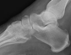 Navicular avulsion