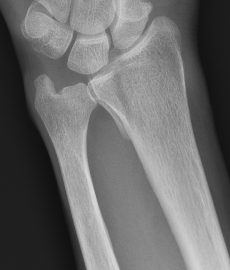 Volar ulna