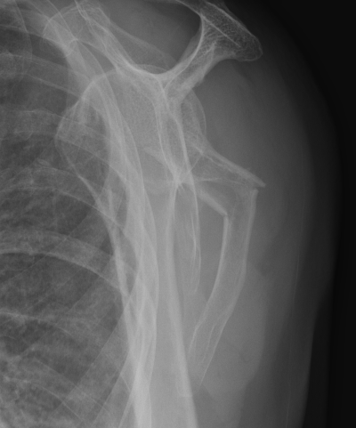 angulation