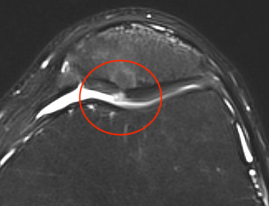 Patella cartilage