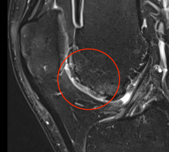 Trochlea MRI