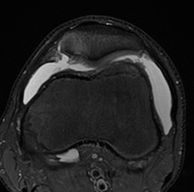 Patella cart