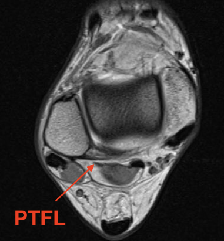 PTFL