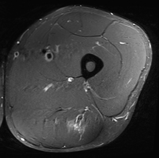 Grade 2b proximal HS