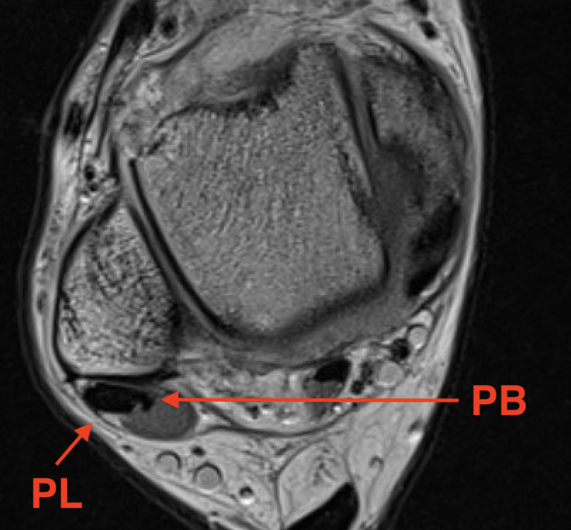 Peroneal MRI anatomy