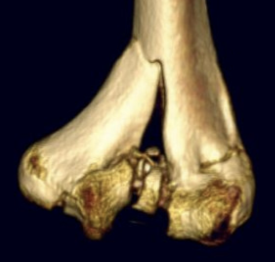 Distal humerus