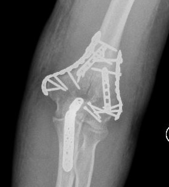 distal humerus