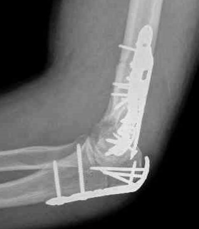 distal humerus