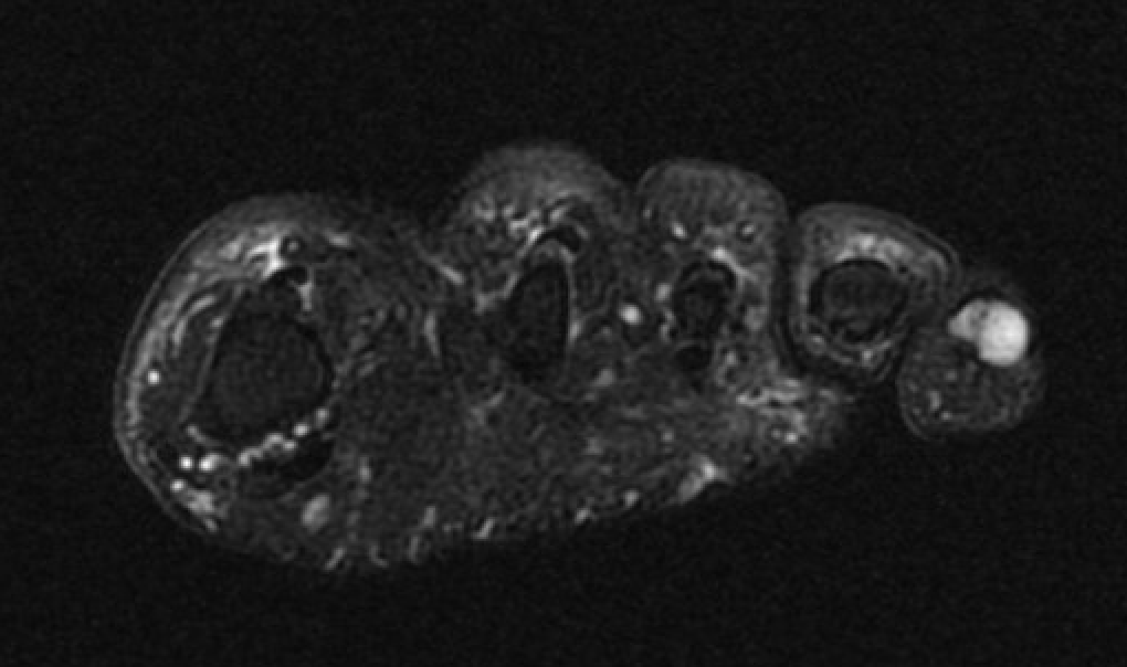 glomus