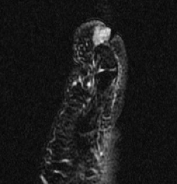 glomus