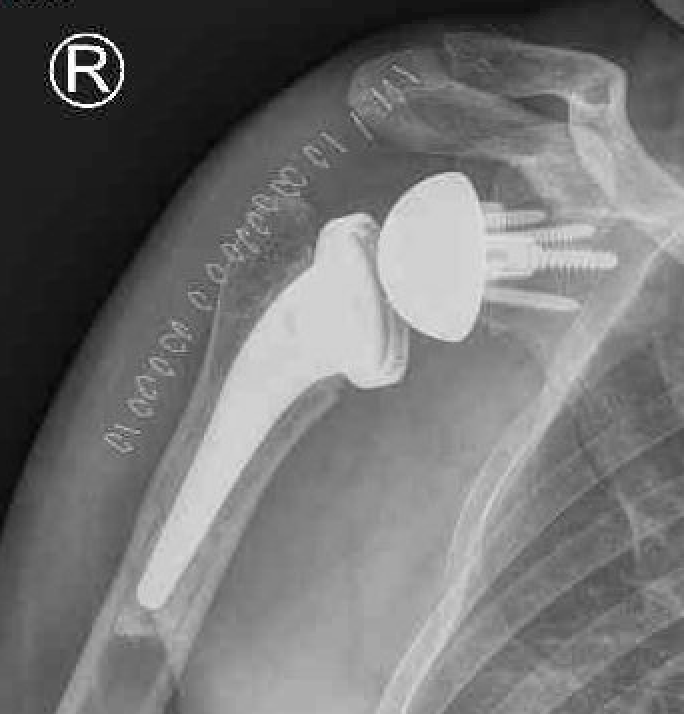 rTSA