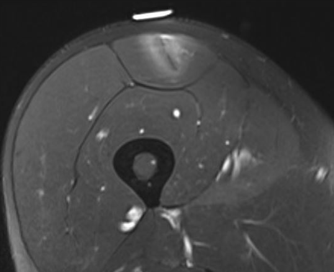 Central tendon