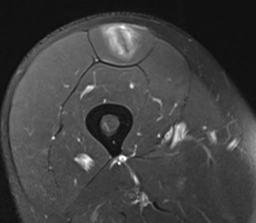 central tendon