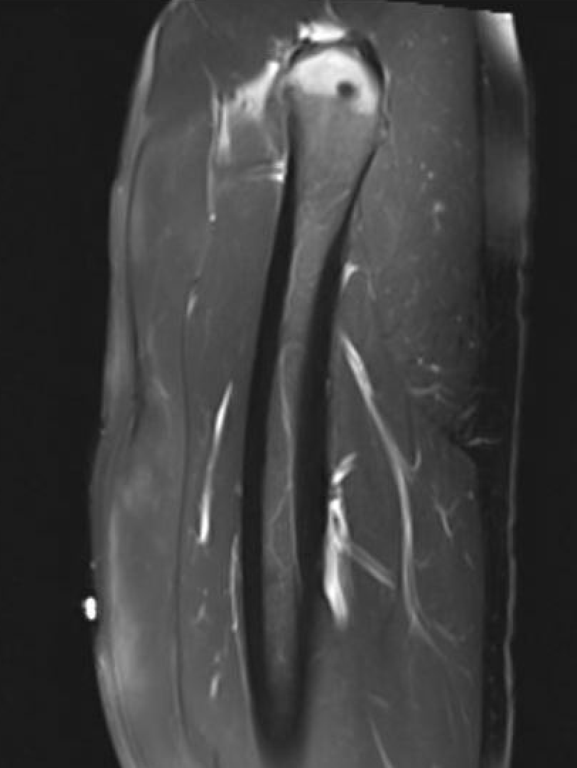 Central tendon