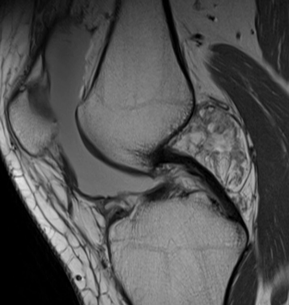 lipoma