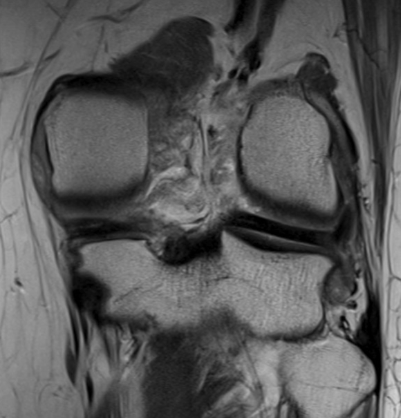 lipoma
