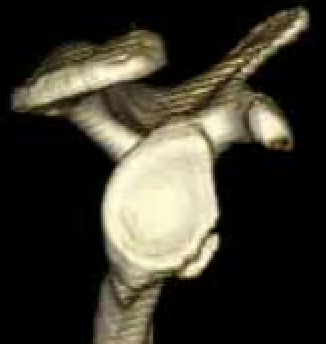 bony bankart