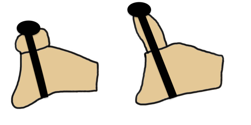 latarjet