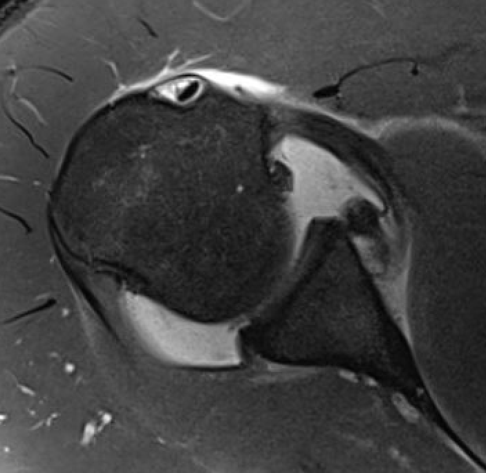 labral tear