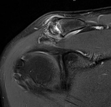 ACJ osteolysis