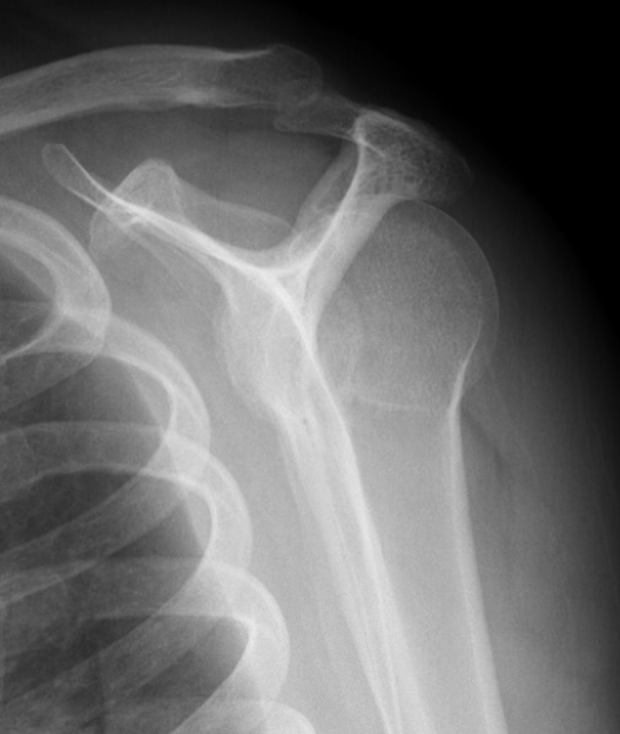 post dislocation