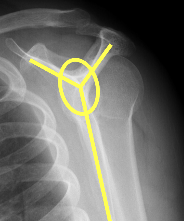 posterior shoulder dislocation