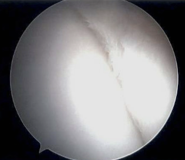 post labrum