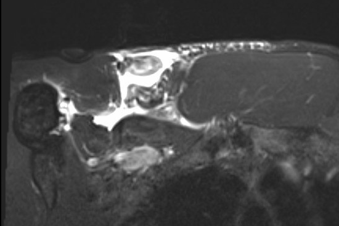 pec tear