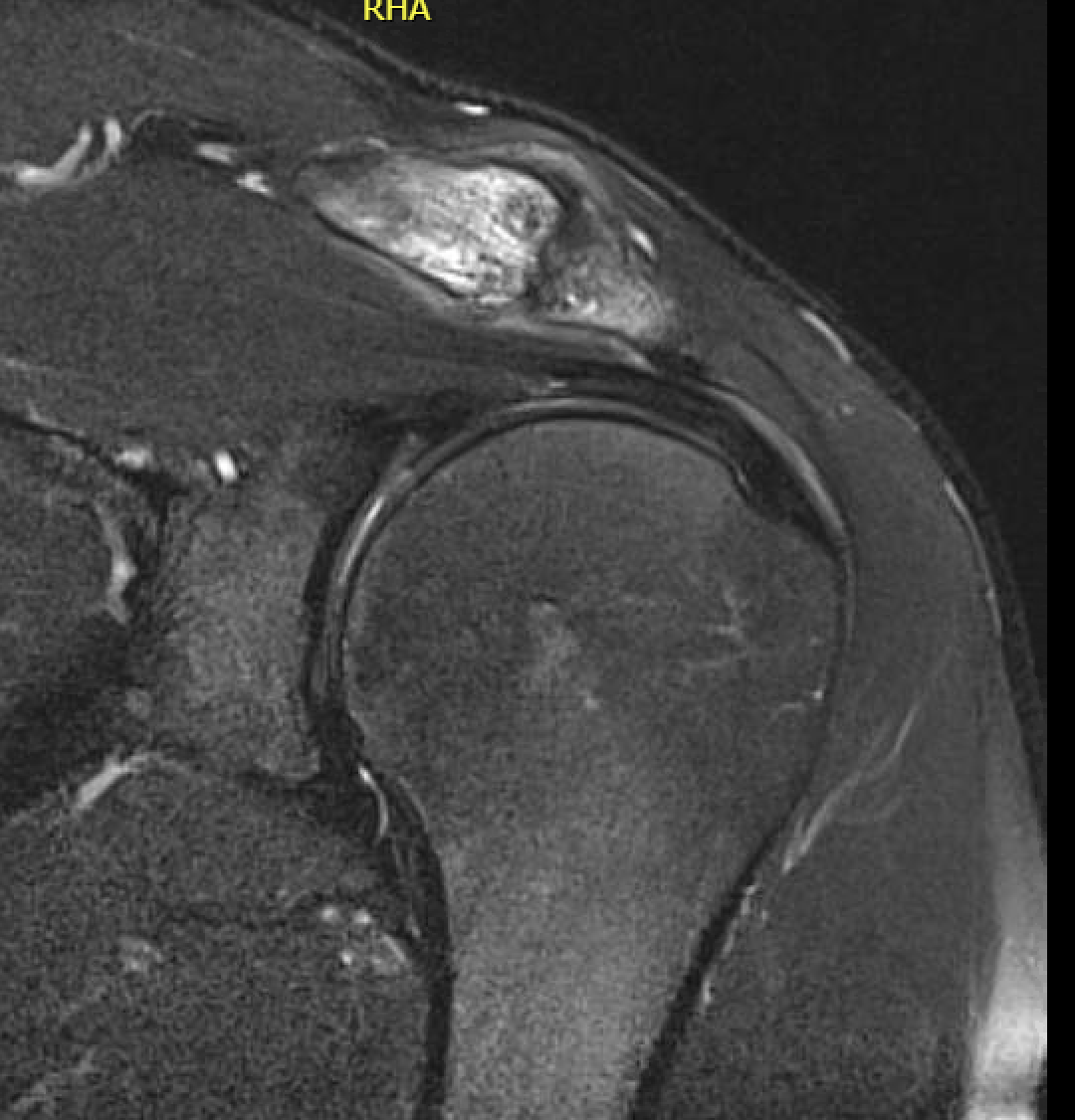 osteolysis
