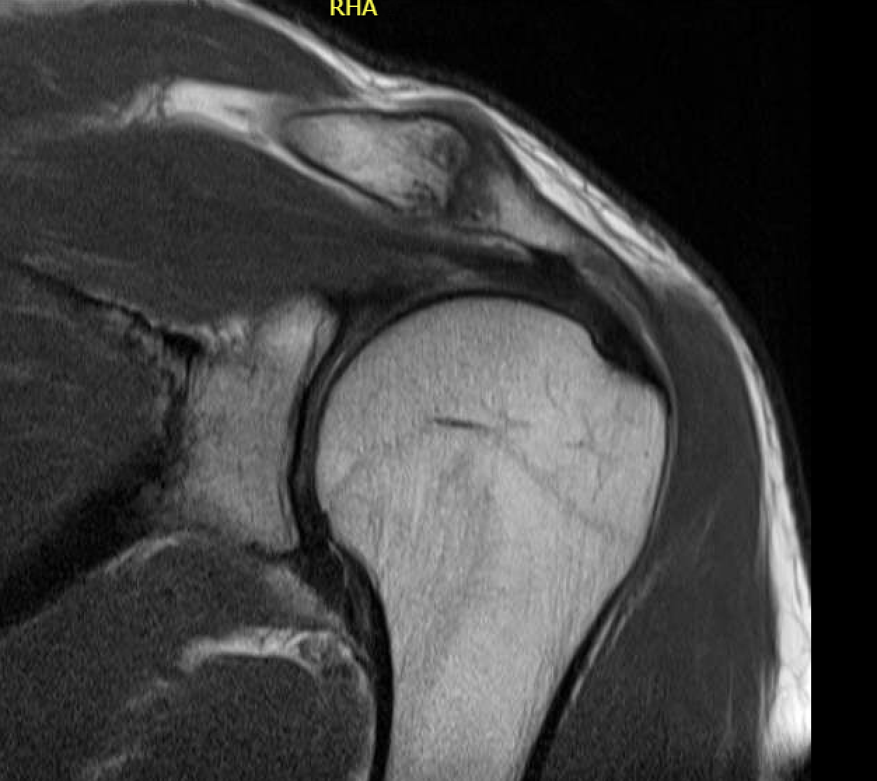 osteolysis