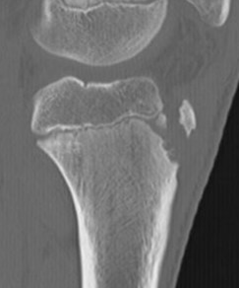 Type I CT