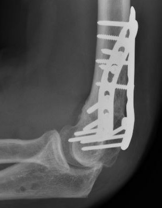 triplane osteotomy