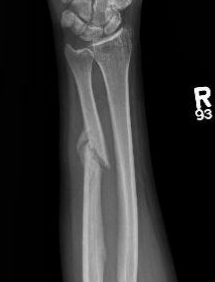 ulna