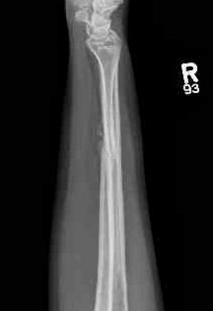 ulna