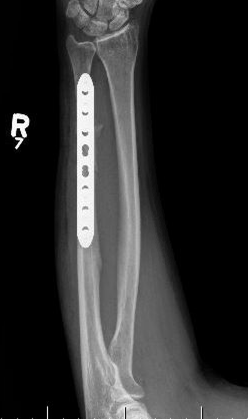 ulna