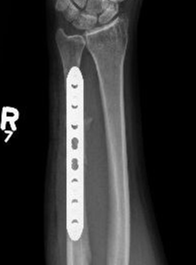 ulna