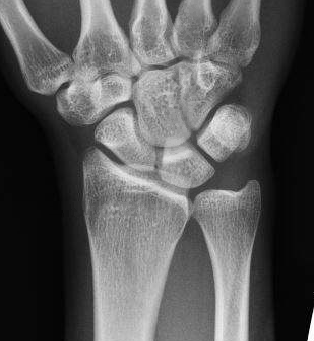 ulna shortening