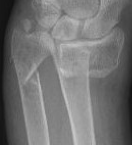 Ulna styloid