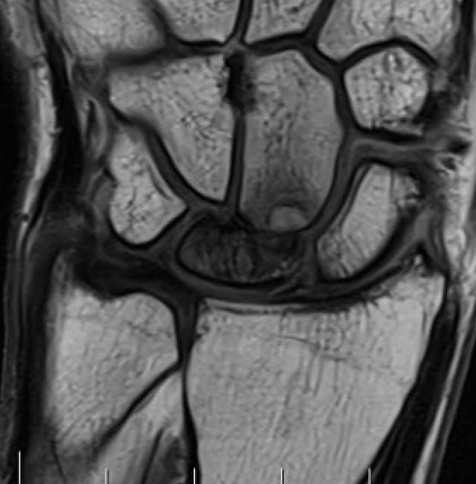 Kien MRI