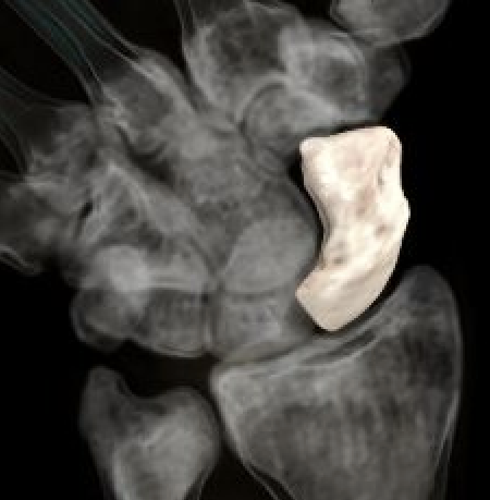 scaphoid