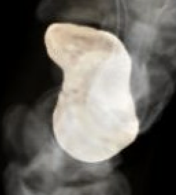 scaphoid