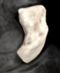 scaphoid