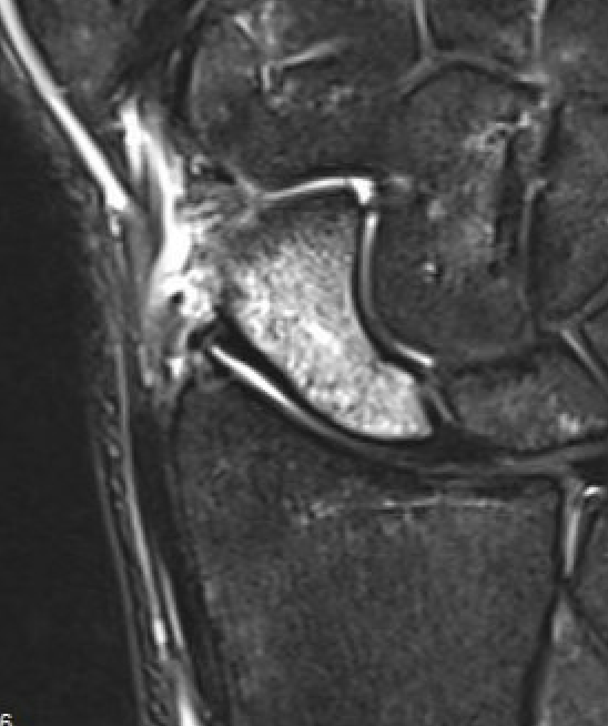 MRI