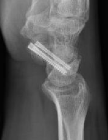 2 screws