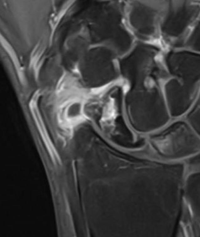 MRI AVN