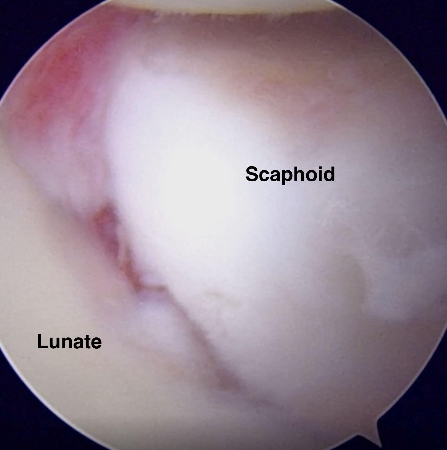 Torn SL ligament