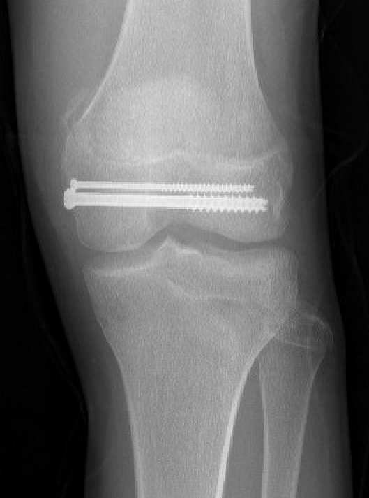 SHIII