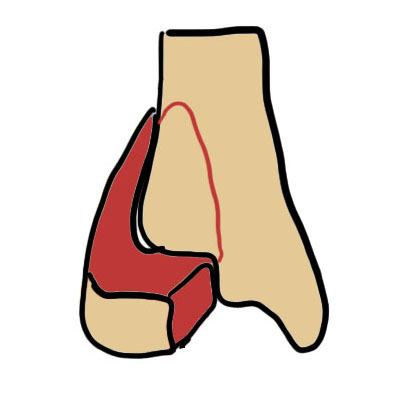 Triplanar