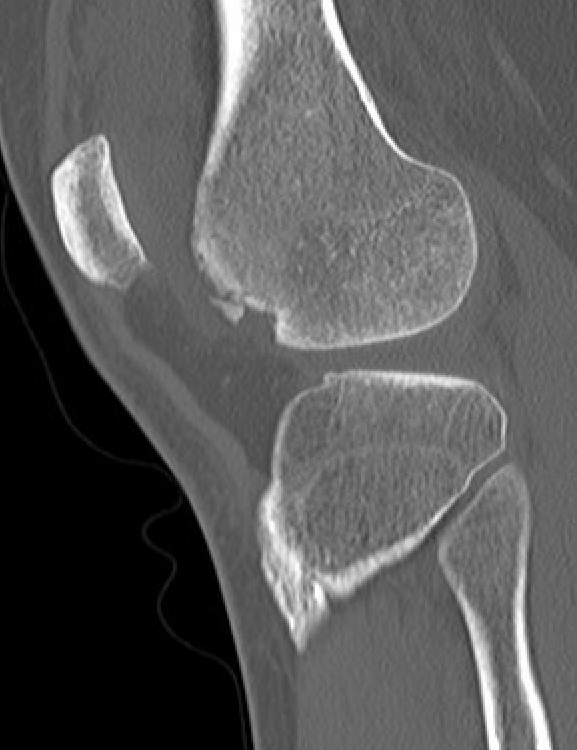 CT PFJ