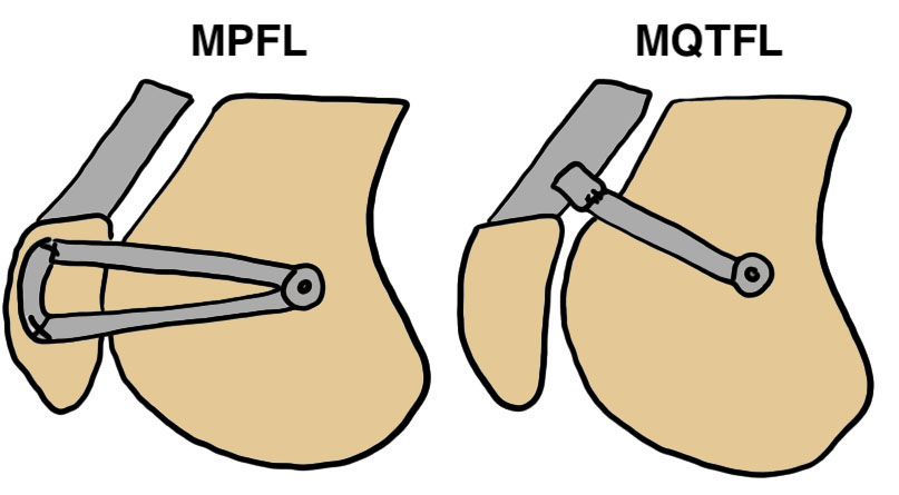 MPFL MQTFL